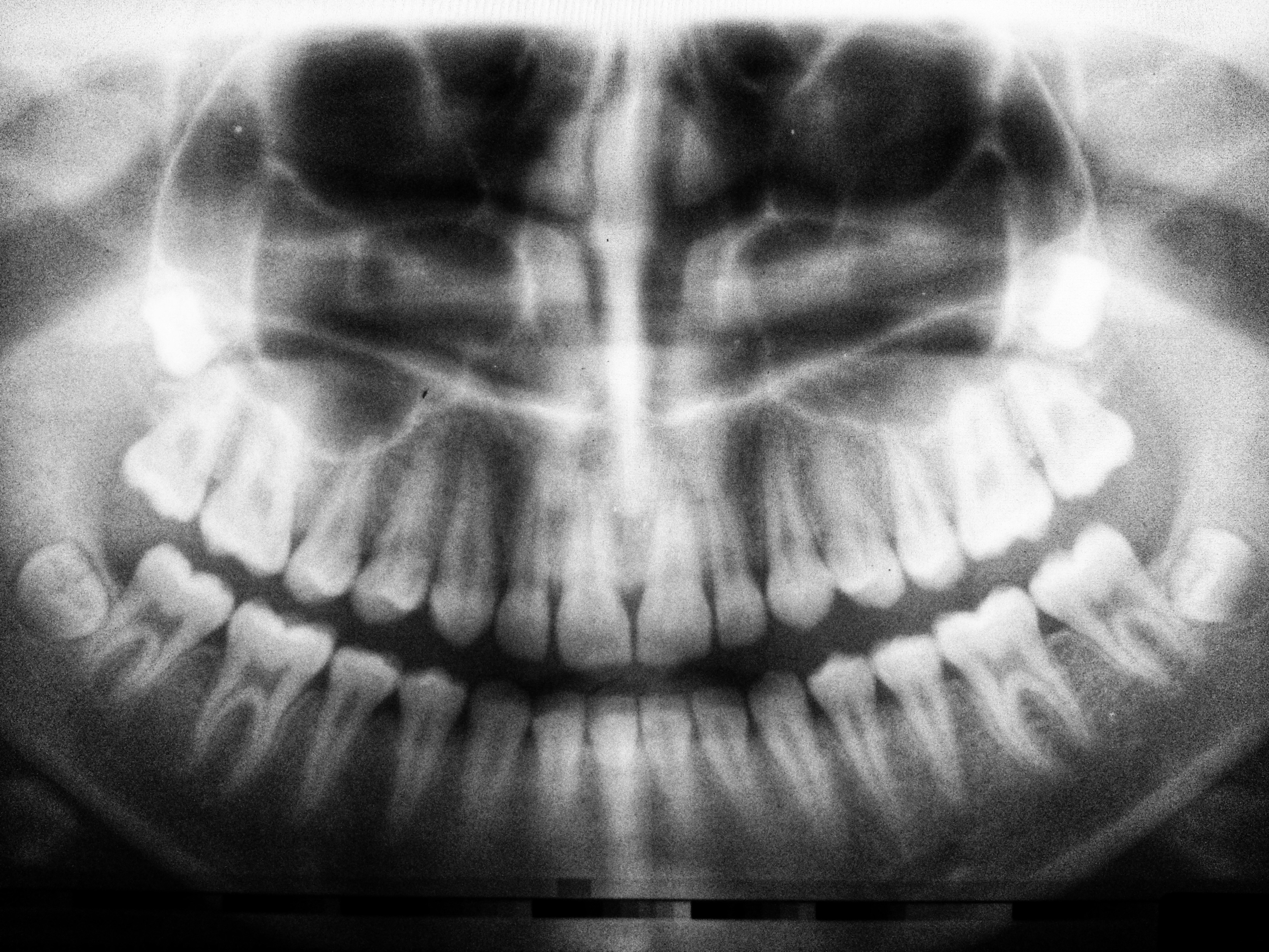 Teeth x-ray